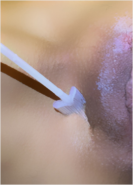 TCA ile Genital Bölge Renk Açma