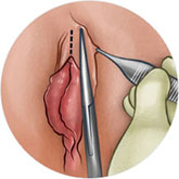 klitoral hudoplasti nedir?