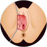 star labioplasti nedir?