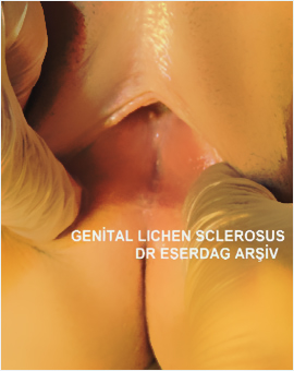 Lichen Sclerosus Disease