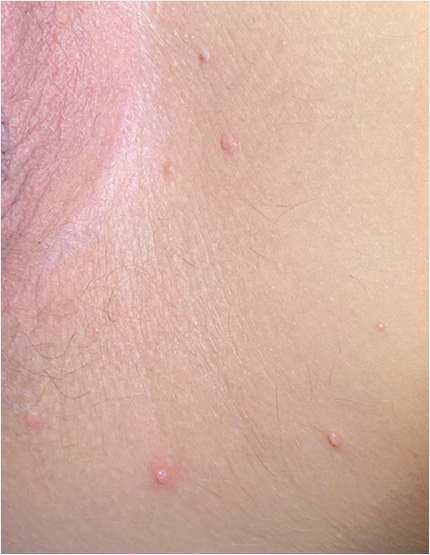 Molluscum Contagiosum